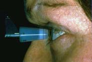 glaucoma 1