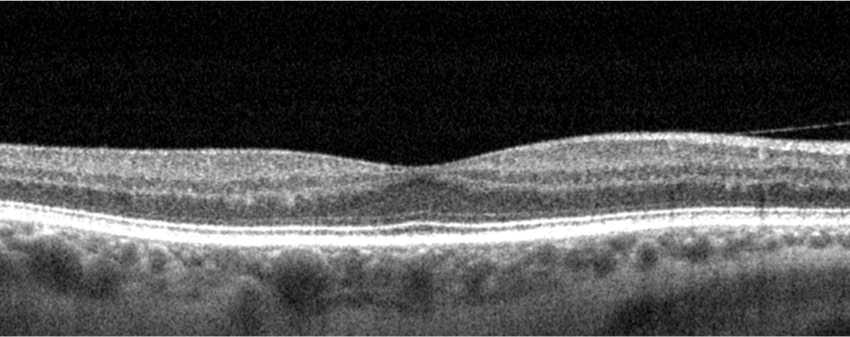 healthyretina oct 1