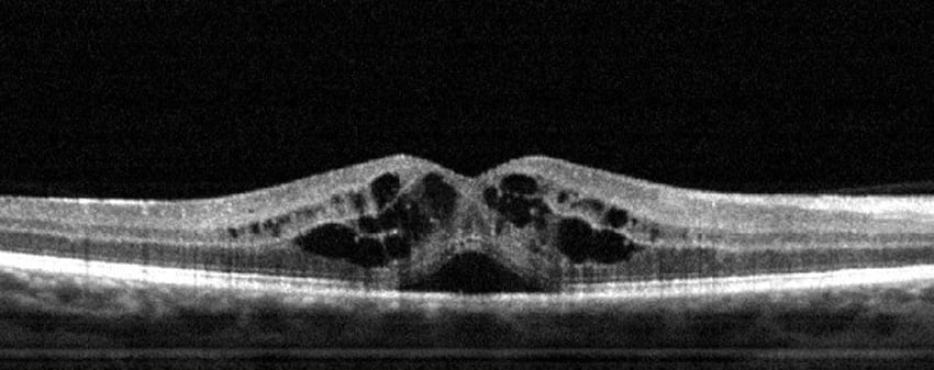 unhealthyretina oct 1