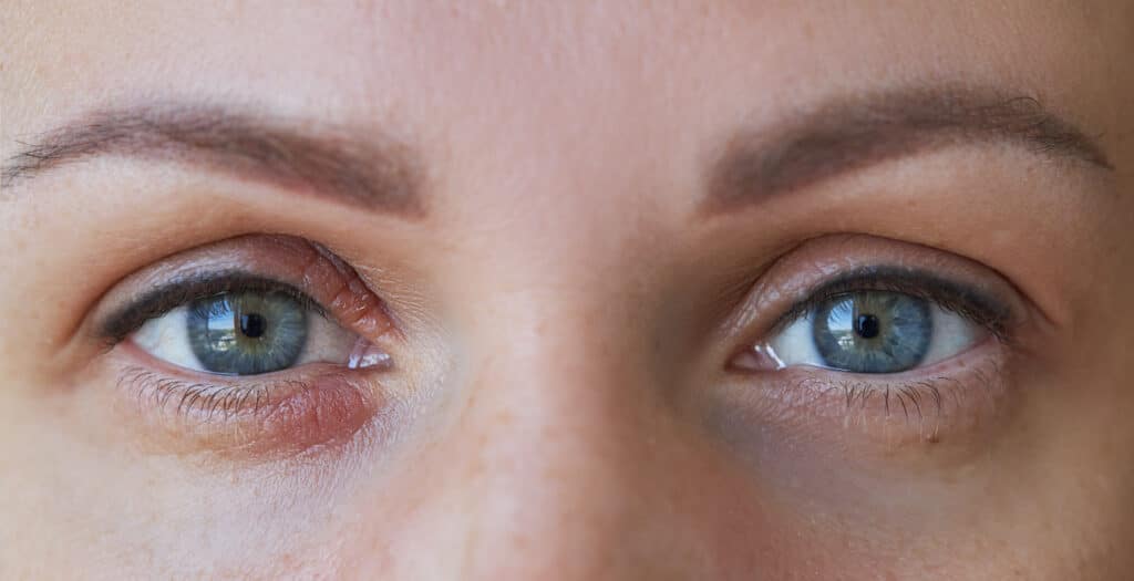 Blepharitis